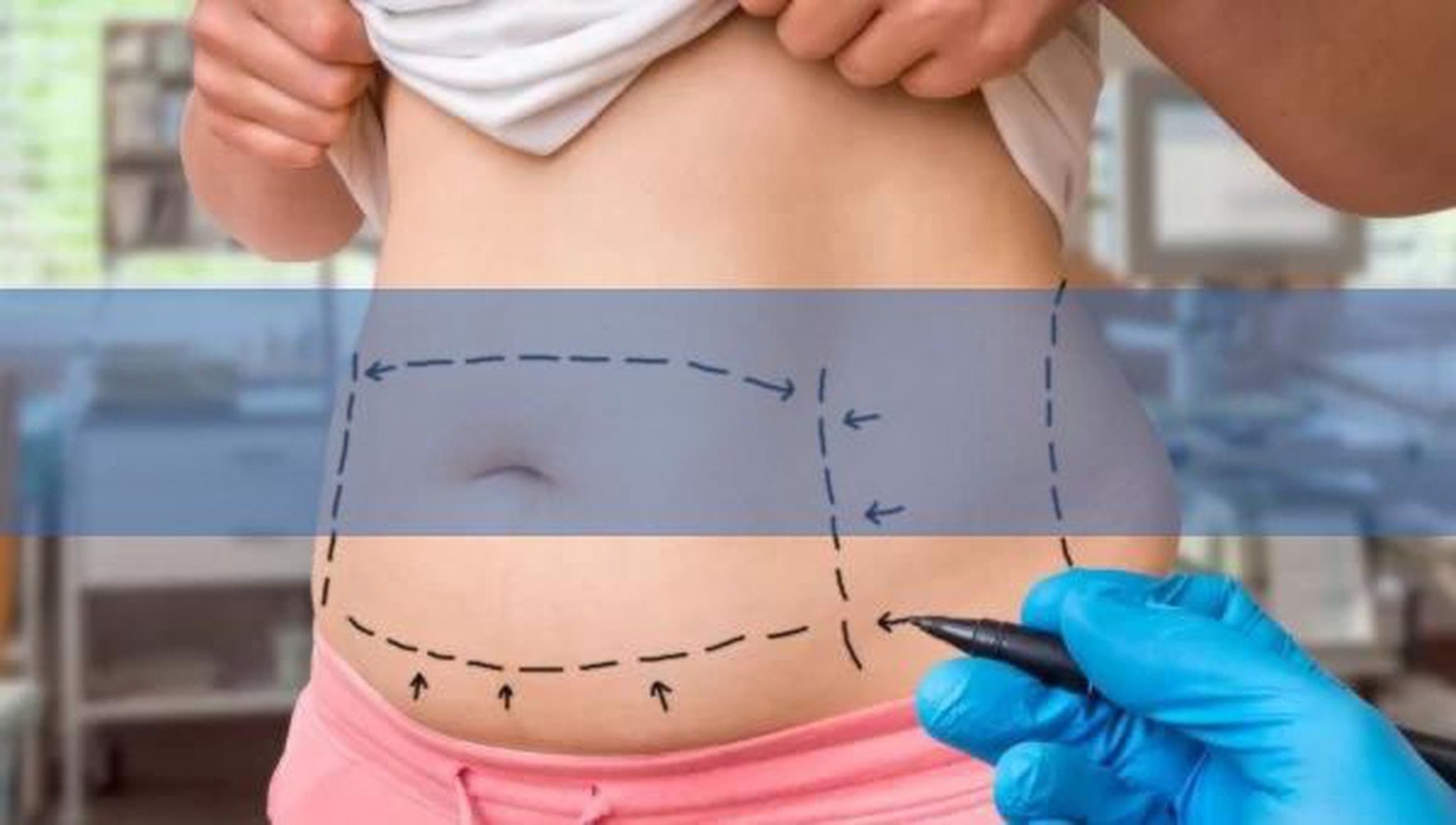 Estética, liposucción y mastectomía