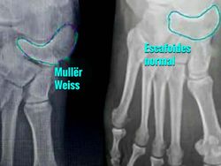 Así es la lesión crónica en el pie de Nadal: la enfermedad de Müller-Weiss