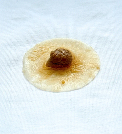 Prótesis de pezon y de areolas