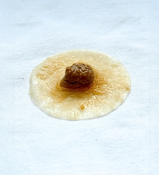 Prótesis de pezon y de areolas