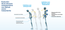 SPINAIR Ortesis de Columna