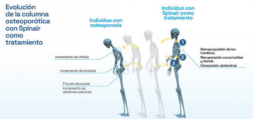 SPINAIR Ortesis de Columna